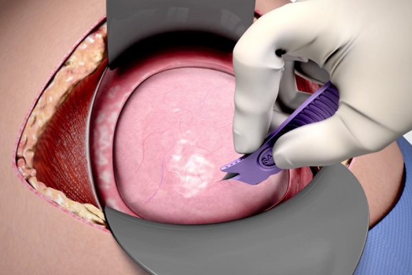 C Safe Safety Scalpel