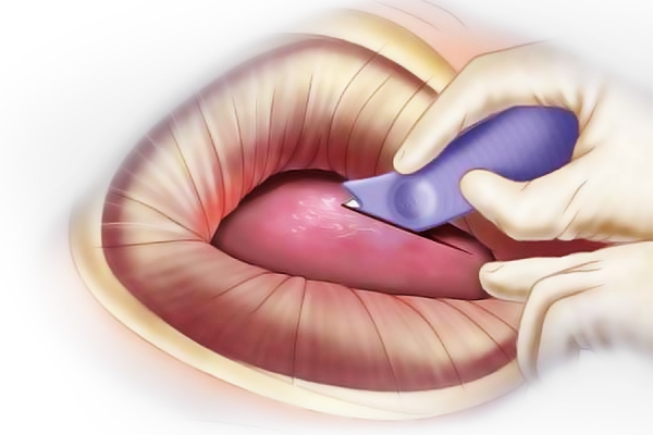 C Safe Safety Scalpel