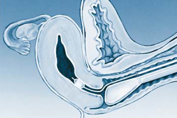 Elliptosphere Catheter